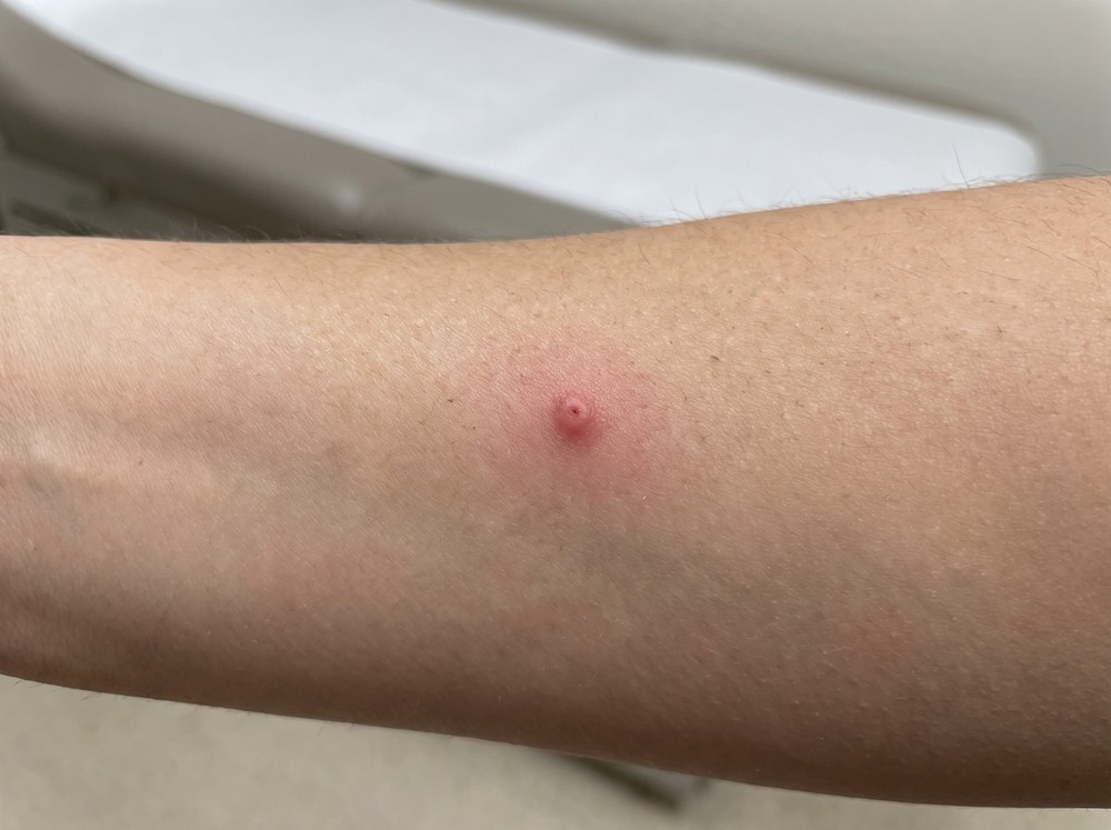 Close-up photo of a small isolated red pinprick mark on human skin from a recent lady beetle bite with mild surrounding redness