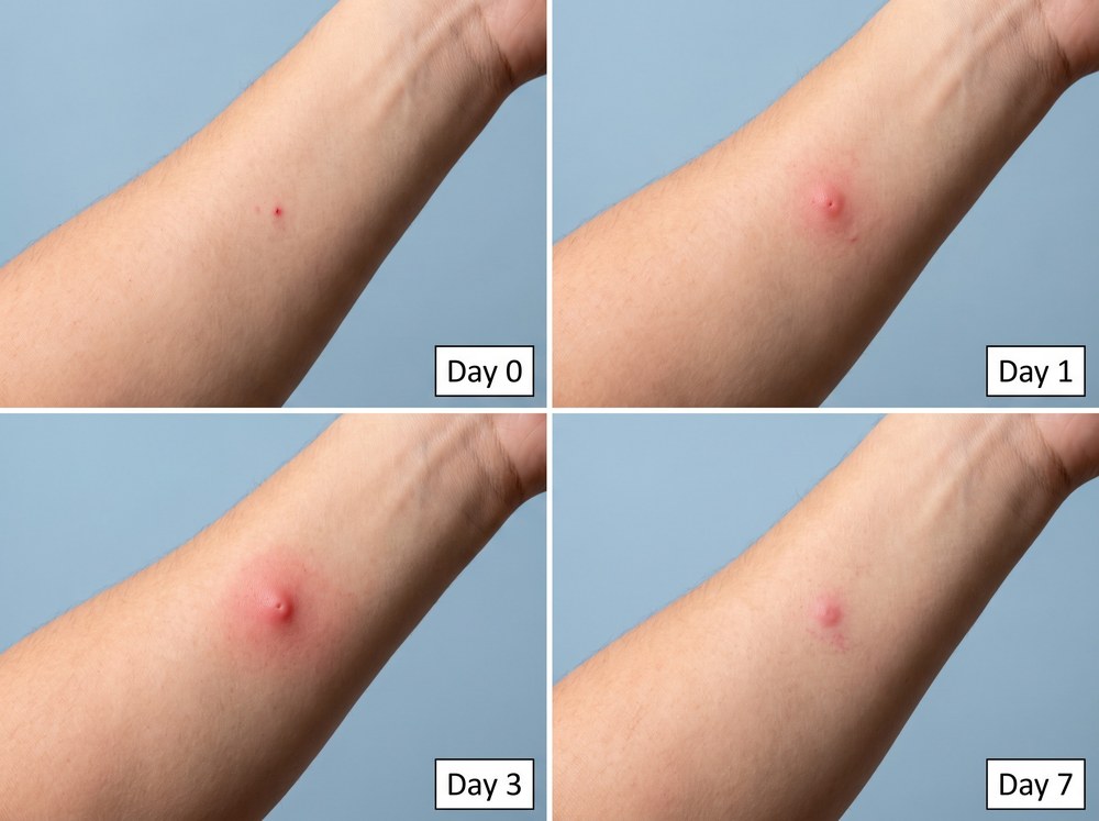 Four-panel comparison photo showing a lady beetle bite mark fading from Day 0 through Day 7 of healing